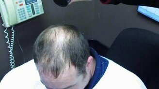 Засыпали мужику лысину - смотреть видео (5:01)