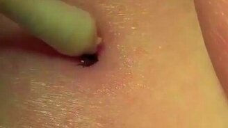 Вариант, как вытащить клеща - смотреть видео (0:54)