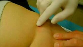 Способ удалить клеща - смотреть видео (0:22)