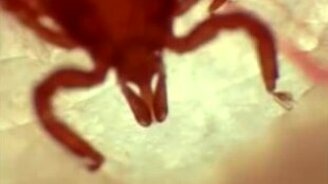 Как клещ проникает под кожу - смотреть видео (3:04)